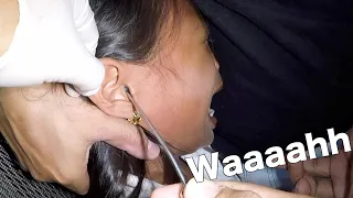 How to Remove a Styrofoam Ball Stuck in Girl's Ear | Can She Handle It?