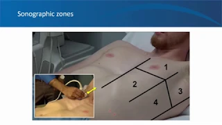 Nephrology ultrasound video 7, Lung, University of Florida Nephrology, Dr. Koratala (@NephroP)