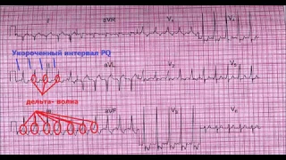 ЭКГ номер 15 - заключение, клиническая интерпретация и что делать