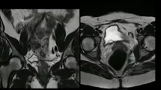 Miomas e ureterocele