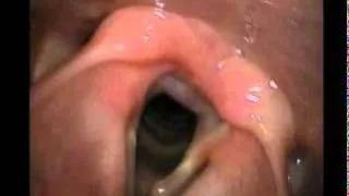 Left Vocal Fold Cyst