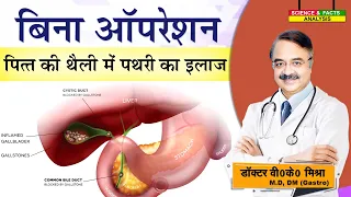 बिना ऑपरेशन पित्त की थैली में पथरी का इलाज || HOW ARE GALL STONES TREATED