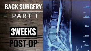 Back Surgery |Laminectomy L4-L5| Recovery part 1