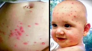 BAD CASE of CHICKEN POX (Varicella) | Dr. Paul