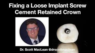 How to Fix Loose Implant Screw on a Cement Retained Crown