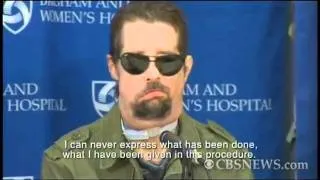 Nation's first face transplant