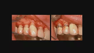 Lecture 23: Esthetic Crown Lengthening part 4: Complex Crown Lengthening