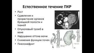 Опухоли почек и мочевого пузыря.