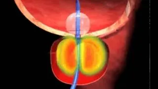 Cooled ThermoTherapy Procedure Animation