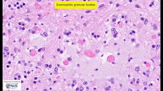 Pilocytic astrocytoma microscopy - Talking slide