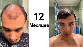 Результат пересадки волос 12 месяцев (1 год)