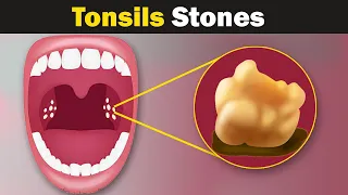 What are Tonsil stones?