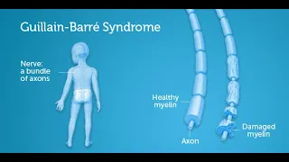 Guillain Barre Syndrome causes signs & symptoms and management