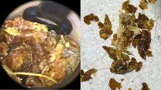 140 - Fully Blocked Dead Skin Extracted & Peeled from Both Ears using WAXscope®️