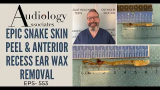 EPIC SKIN RIBBON & ANTERIOR RECESS EAR WAX REMOVAL - EP553