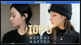 [Plastic Surgery in Korea] TOP 5 Plastic Surgery Before and After at DA!