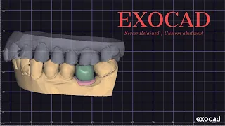 Master CAD Design in Exocad: Screw-Retained & Custom Abutment Implant Crowns