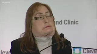 Doctors salute the life of Connie Culp, recipient of the first US face transplant at Cleveland Clini