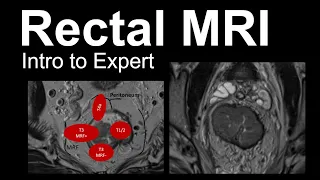Rectal MRI: Intro to Expert, Rectal Cancer Staging