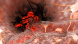 Hemorrhagic Stroke (Brain Hemorrhage)