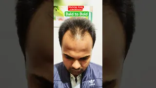 Omg 😱 Transformation #hair #hairtransplant