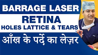 Barrage Laser (बैराज लेजर) - आँख के परदे का लेजर | Treatment for Retinal Lattice, Holes & Tears