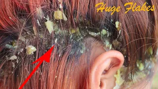 Dandruff Removal!!! Scratching Dandruff Huge Flakes On His Left Side Of Head # 126