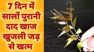 बस 7 दिन में सालों पुरानी दाद खाज खुजली जड़ से ख़त्म बिना दवाई के Natural way to cure Ringworm khujli