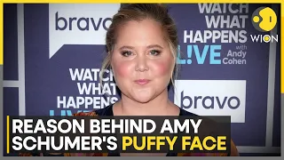 Amy Schumer suffers from Cushing's Syndrome | What is Cushing Syndrome? | Entertainment News