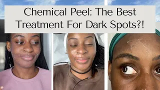 HOW I GOT RID OF MY ACNE SCARS! TCA Chemical Peel | Procedure + Before and After