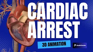 Cardiac Arrest (Sudden Death) - 3D Animation