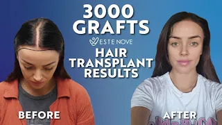 Female Hair Transplant in Turkey | Rachel's New Hair | Before and After