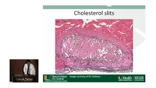 Bascom Palmer Grand Rounds - Coats Disease