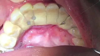 Houston Cosmetic Dentist...Worst Tartar I have seen! Watch how we remove it...