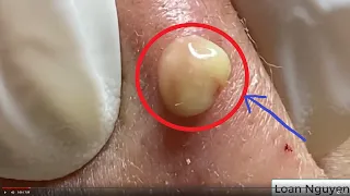 REMOVAL lage CYST AND SUC | Loan Nguyen