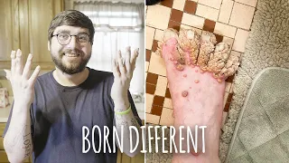 My Hands And Feet Are Covered In Growths | BORN DIFFERENT