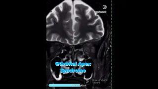 Orbital apex syndrome #ct #mri