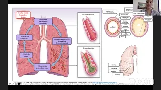 Tamizaje de Fibrosis Quística y Datos de Alarma en el Recién Nacido   Sesión Acad