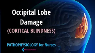 Cortical Blindness: Occipital Lobe Damage Nursing Pathophysiology in a Minute