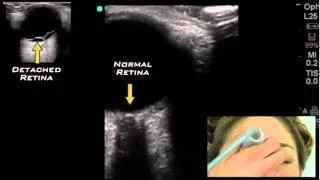 Ocular Ultrasound from One Minute Ultrasound