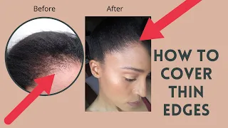 How to Cover Thin Edges, Traction Alopecia, Balding