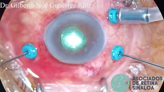 Vitrectomy in endophthalmitis due to vegetal trauma