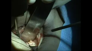 Repair of orbital fracture without canthotomy or cantholysis