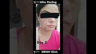 How skin peel off after chemical peeling | Best peeling results | AWISH Clinic #peeling #peel #short