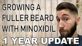 Minoxidil Beard - 1 Year - Before and After Pic