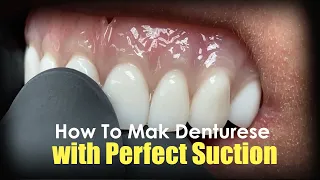 How to Make Dentures with Perfect Suction