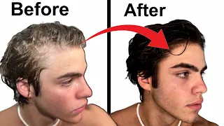 How To Stop Balding | Full hair loss guide