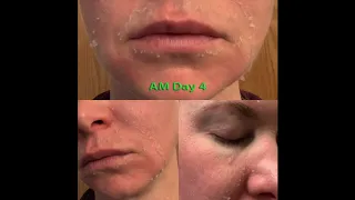 Day by Day Progress (How skin looks while recovering from a superficial skin peel)