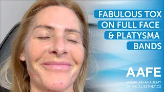 Fabulous Tox on Full Face & Platysma Bands