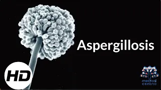 Aspergillosis: Everything You Need To Know